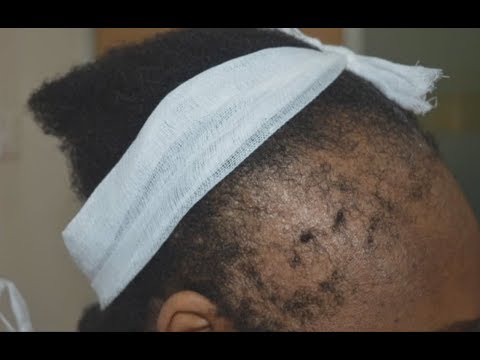 Alopécie, le côté sombre de nos coiffures *** BBC Afrique