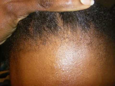 How to grow edges with Castor oil and Essentials oil/ Serum pour les tempes dégarnies.